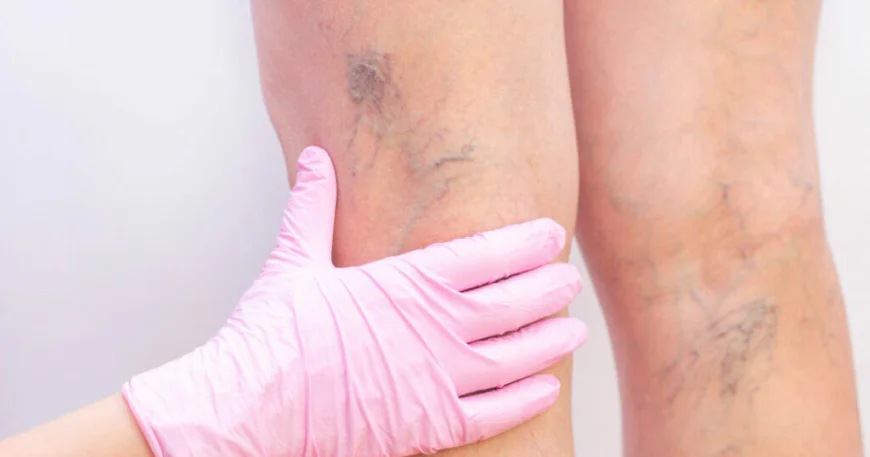 How Is Varicose Vein Treatment Carried Out?