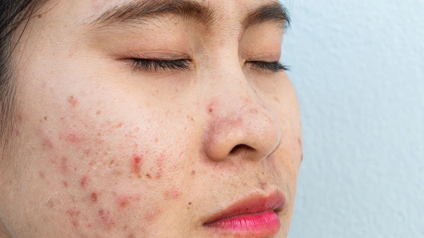 Is Acne Scar Treatment Linked to Skin Healing?