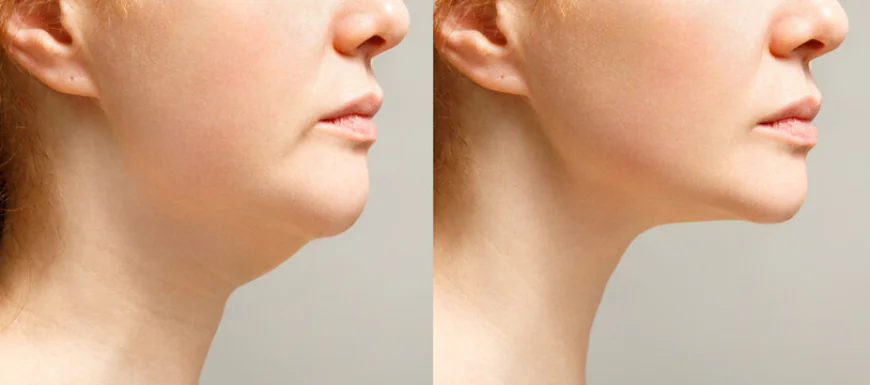 Double Chin Liposuction: A Modern Solution for a Sharper Look