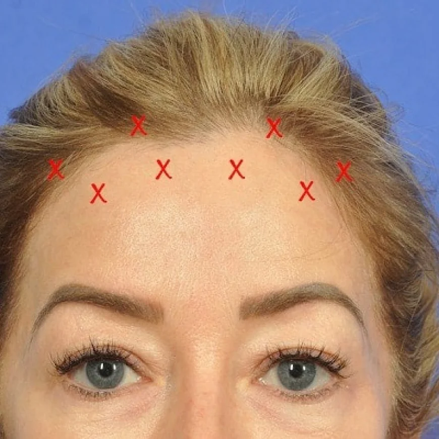 جراحة شد الجبهة ونتائج شبابية