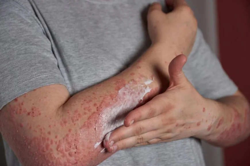 Fungal vs Bacterial Skin Infections: Understanding the Difference for Effective Treatment