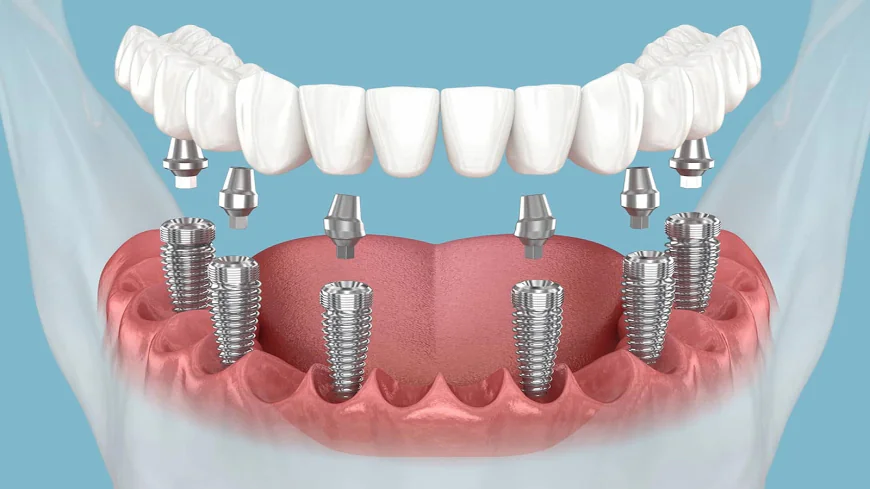 Clear vs. Traditional Braces in Dubai: Which Is Better?