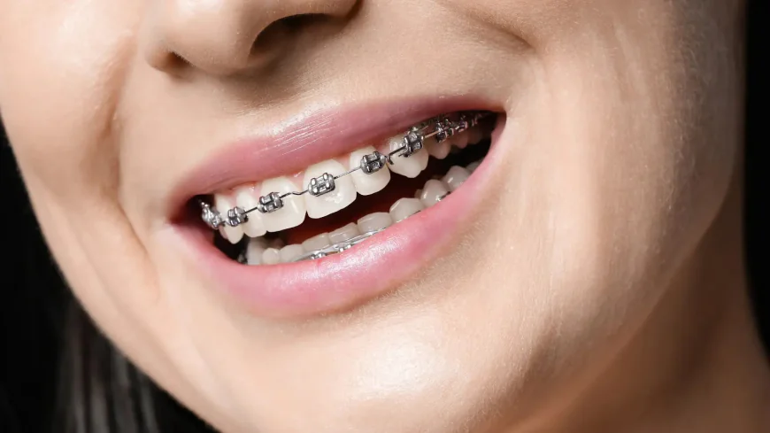 Metal vs Ceramic Braces in Dubai: Which Is Better?