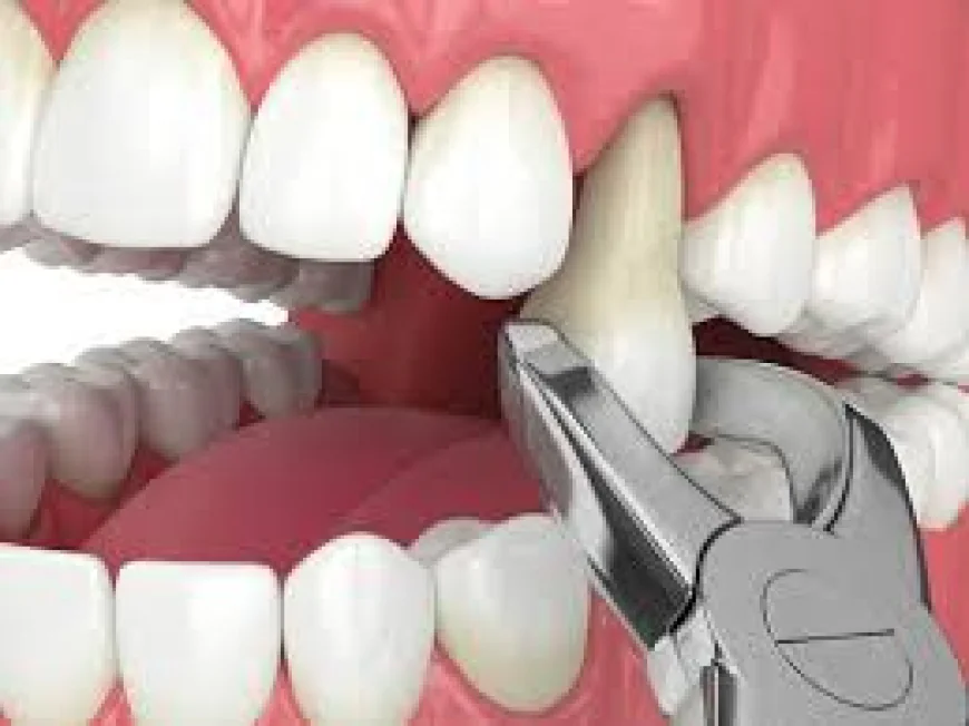 What Is Tooth Removal and When Is It Needed?