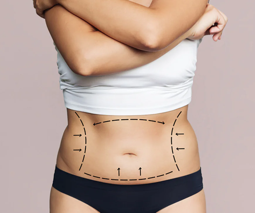What Is a Tummy Tuck Procedure?