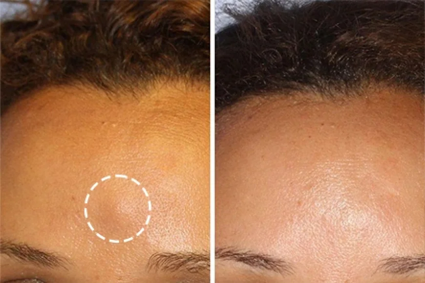 Best Lipoma Removal Surgery Clinic