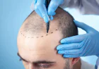Recovery timeline after a hair transplant