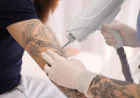 Laser tattoo removal basics for beginners in Riyadh