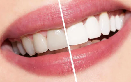 Teeth Whitening Cost in Dubai: Expert Advice for First-Time Patients