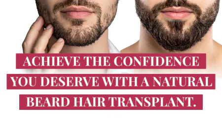 Is Beard Hair Transplant Worth Investing?