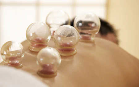 Hijama Cupping Therapy for Holistic Healing