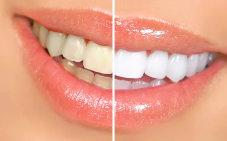 Bright Smile Solutions With Professional Teeth Whitening