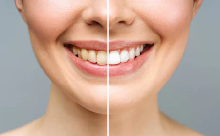 Achieve a Dazzling Smile with Teeth Whitening in Islamabad