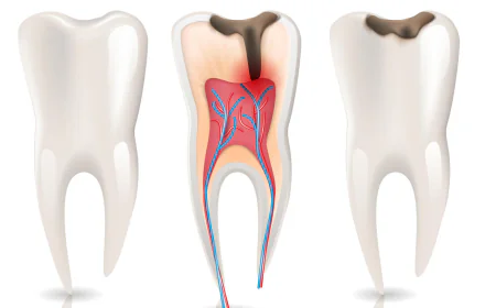 Root Canal Treatment vs Tooth Extraction in Dubai