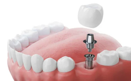 Restore Confidence and Function with Advanced Dental Implants