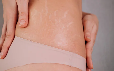 Is Stretch Marks Removal linked collagen changes