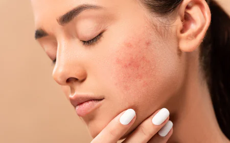 Acne Treatment for Sensitive Skin: Safe and Proven Methods