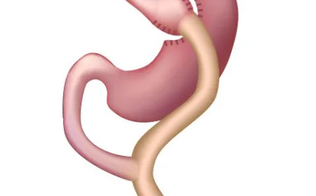 How Does Gastric Bypass Surgery Work?