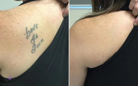 Tattoo Removal for Colored Ink: What Works Best?