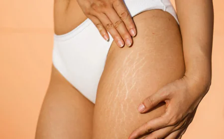 Your Guide to Informed Stretch Marks Removal