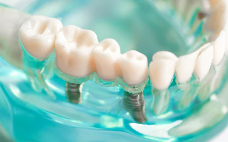 Dental Implant Cost In Dubai: What Affects Pricing