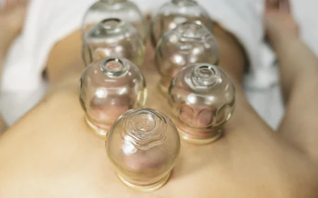 Cupping Therapy Treatment for Sports Injuries and Recovery: A Complete Guide