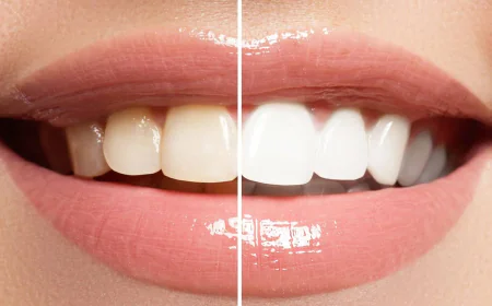 Teeth Whitening in Dubai: Cost, Benefits & Results
