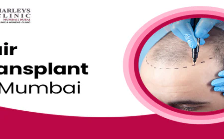 How to Plan the Expenses for Hair Transplant Surgery