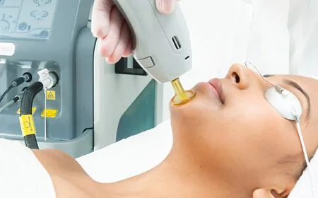Laser Hair Removal in Islamabad: A Long-Term Solution for Effortless Smooth Skin