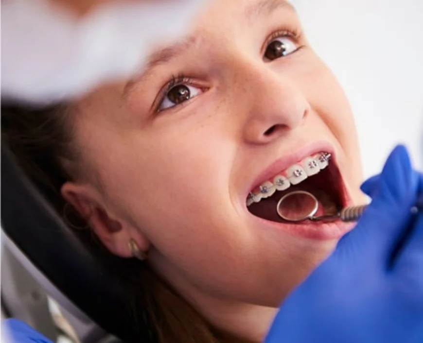 Achieve a Confident Smile with Teeth Straightening Adelaide at Dental Excellence