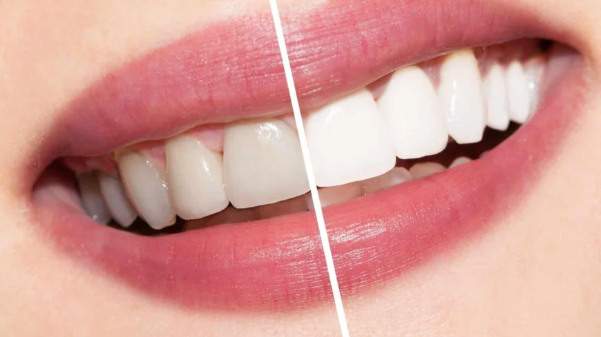 Teeth Whitening Cost in Dubai: Expert Advice for First-Time Patients