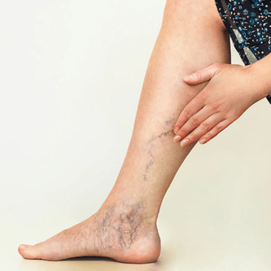 Which Conditions Can Be Treated with Sclerotherapy?