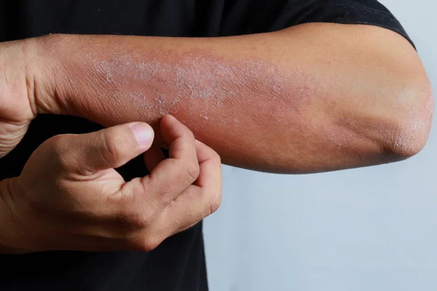 How Do Treatments Help Manage Eczema Symptoms?