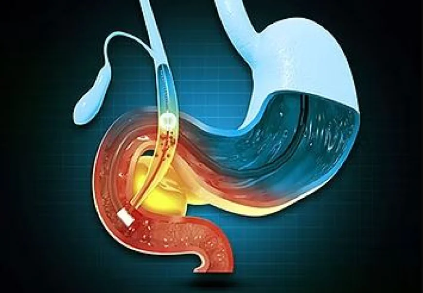 Recurring Upper Abdominal Pain? It Might Be Time to See a Gallbladder Specialist