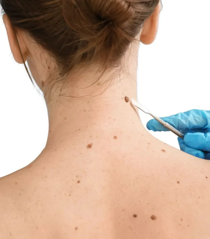 Mole Removal in Dubai: A Complete Comparison of Treatment Methods