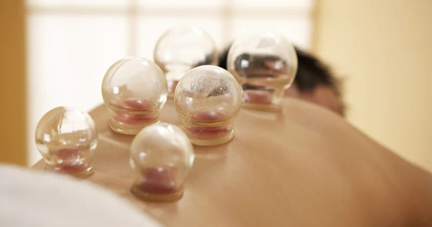 Hijama Cupping Therapy for Holistic Healing