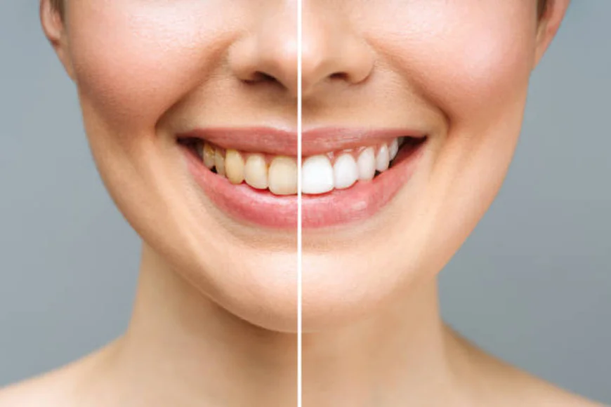 Achieve a Dazzling Smile with Teeth Whitening in Islamabad