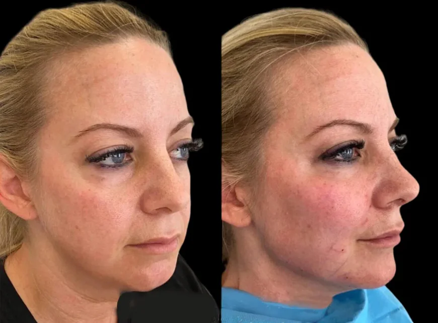 The Ultimate Guide to Cheek Fillers Treatment in Dubai