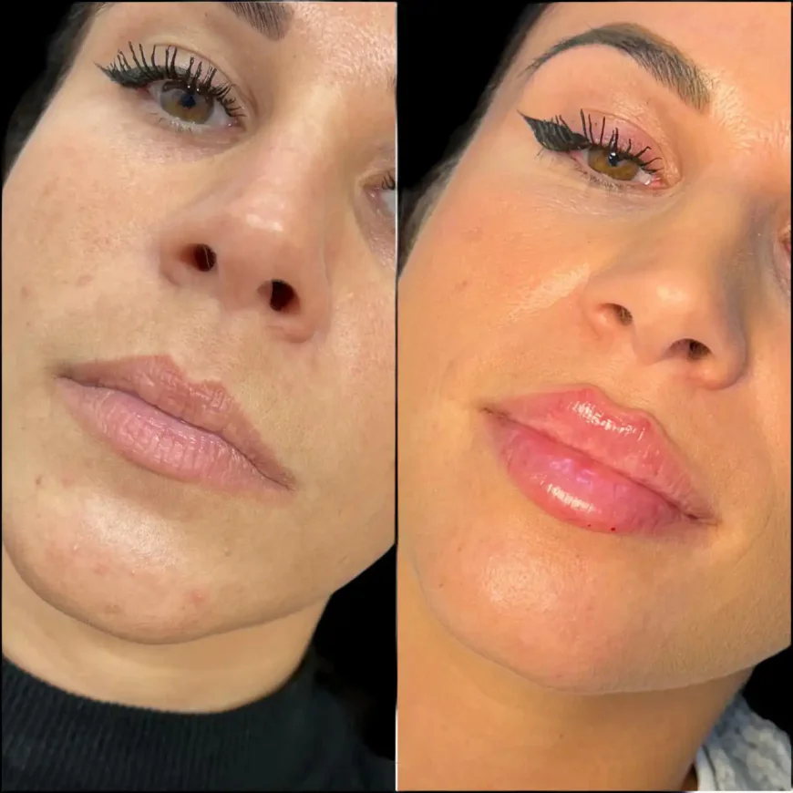 Affordable Dermal Fillers Treatment in Dubai with Visible Results