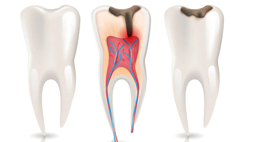 Root Canal Treatment vs Tooth Extraction in Dubai