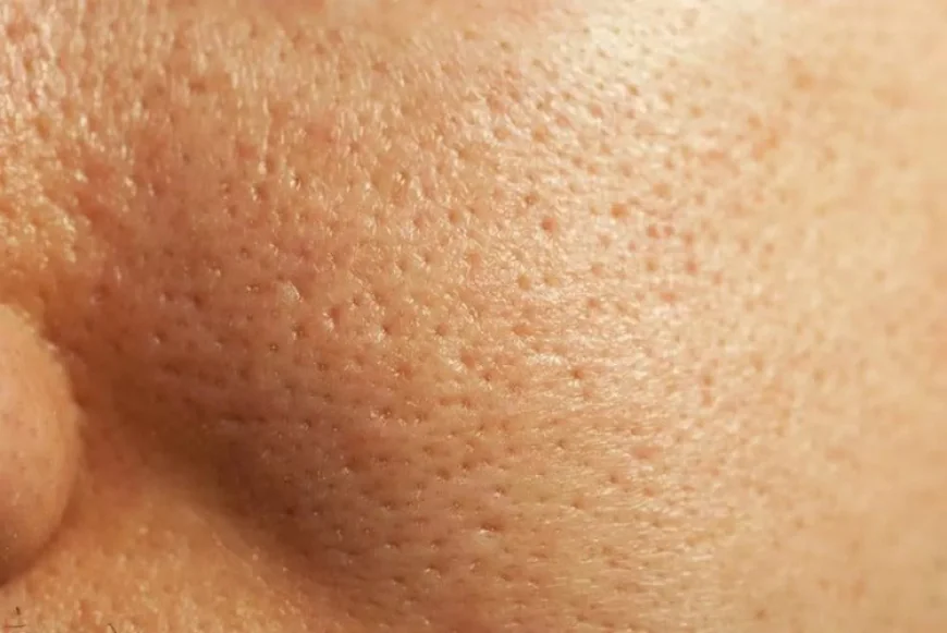 How Large Pores Treatment Targets Skin Structure?