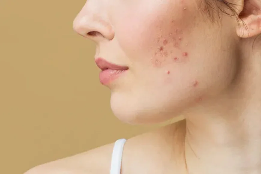 Pimples Treatment in Dubai: Science-Backed Skin Healing