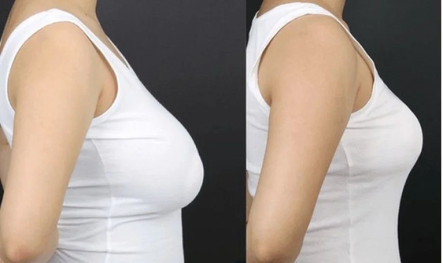 Look & Feel Confident: Breast Reduction in Islamabad