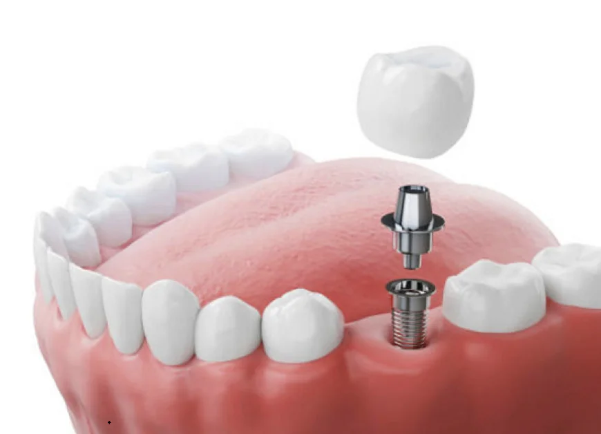 Restore Confidence and Function with Advanced Dental Implants