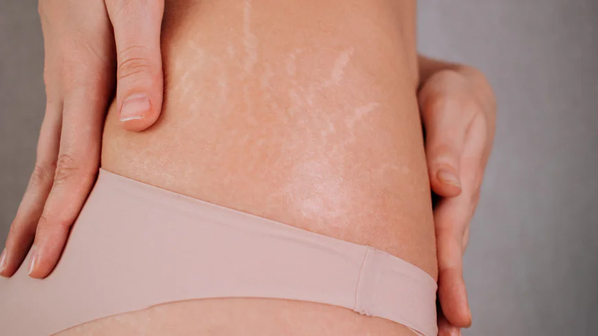 Is Stretch Marks Removal linked collagen changes