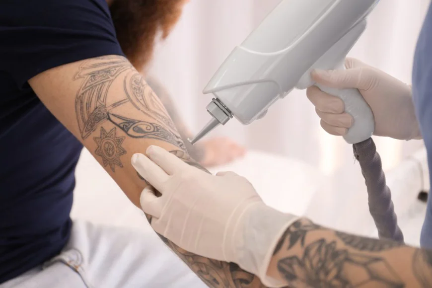 Laser tattoo removal basics for beginners in Riyadh