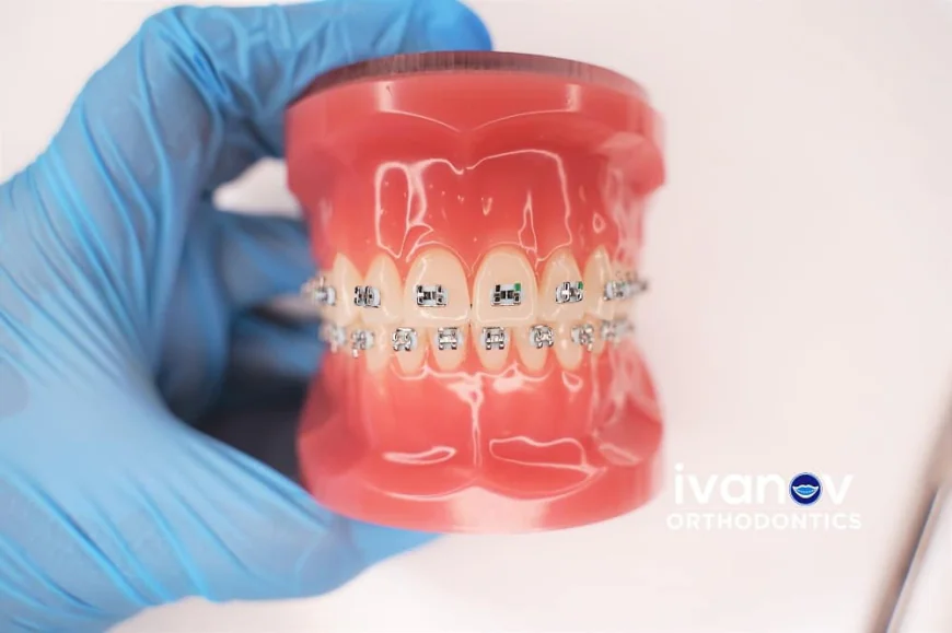 Why Are More Adults Choosing Braces for Teeth Alignment?