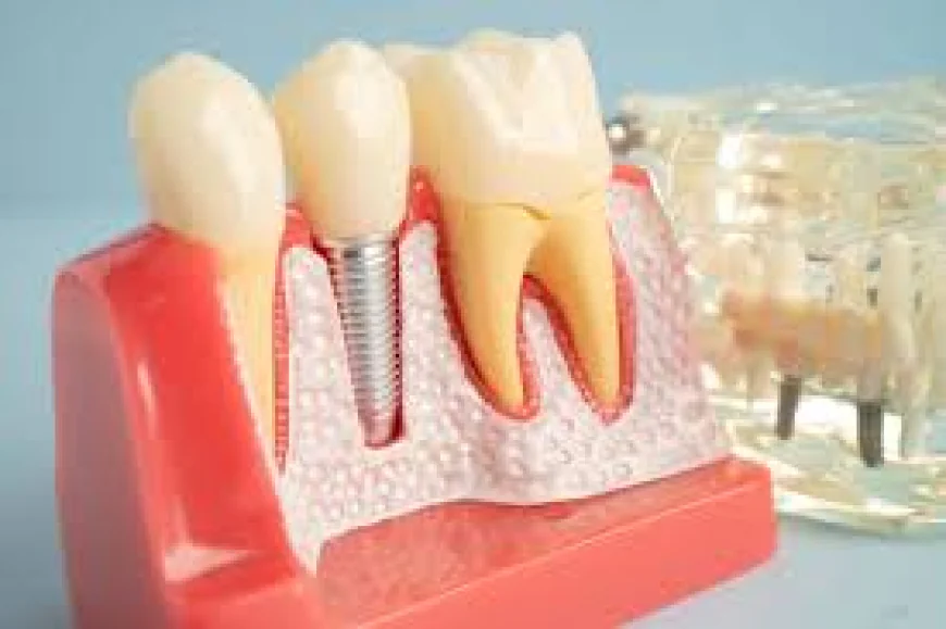 Smile Your Way: Personalized Dental Care & Single Tooth Implants in Houston