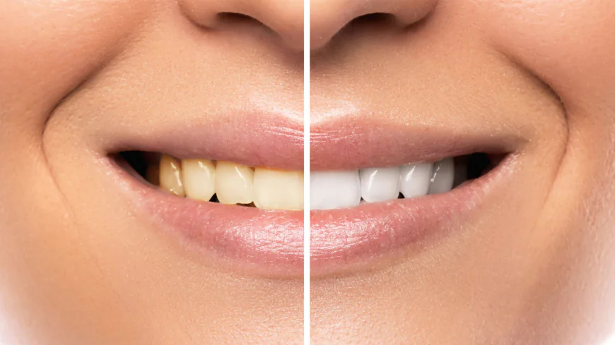 Teeth Whitening in Dubai: Affordable Options Guide