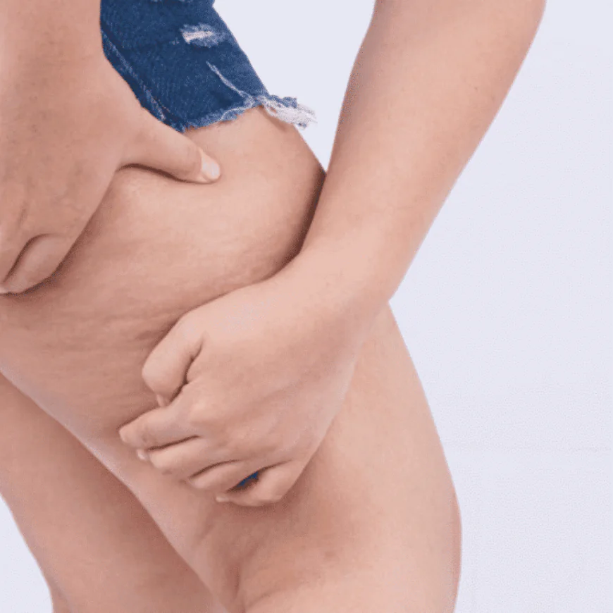 Is Cellfina Effective for Treating Cellulite?